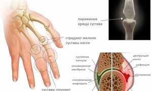 Лечение пауциартикулярного юношеского артрита у детей