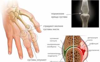 Лечение пауциартикулярного юношеского артрита у детей