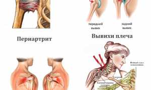 Выполнение гимнастики при болях в плечевом суставе для улучшения состояния