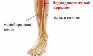 Лечение при переломе по типу зеленой веточки у детей: советы и рекомендации