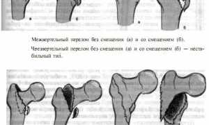 Что делать при чрезвертельном переломе бедра? Полезные советы и рекомендации