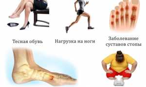 Чем опасно развитие гигромы на ноге и чем ее лечить? Узнайте важные детали