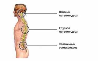 Правильное положение для сна при остеохондрозе: советы и рекомендации
