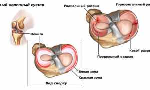 Симптомы и способы лечения менископатии коленного сустава у спортсменов
