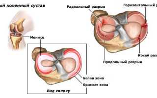 Симптомы и способы лечения менископатии коленного сустава у спортсменов