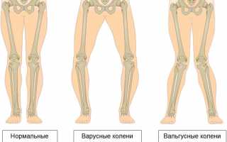 Лечение вальгусного искривления ног у ребенка: советы и рекомендации
