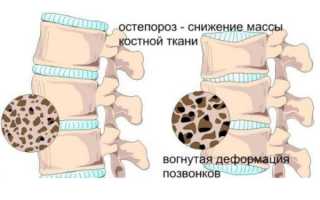 Препараты кальция при остеопорозе: выбор средства для здоровья