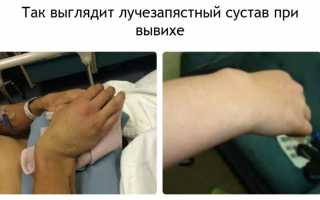 Лечение и восстановление при вывихе кисти руки: советы и рекомендации
