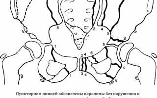 Характерные признаки перелома таза и его лечение: важные аспекты и рекомендации