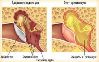 Гнойный отит чем промывать ухо