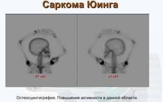Для чего проводят остеосцинтиграфию костей скелета? Полное руководство