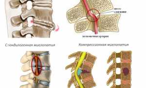 Миелопатия спинного мозга, виды и методы лечения: причины и профилактика