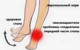 Диагностика пареза ступни при грыже позвоночника и его лечение: важные аспекты