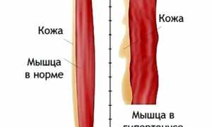 Каковы причины возникновения миалгии и чем ее лечить? Полное руководство