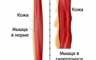 Каковы причины возникновения миалгии и чем ее лечить? Полное руководство