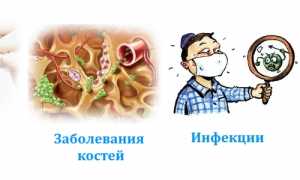 Почему возникает саркома бедренной кости и как ее убрать? Полное руководство
