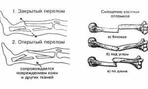 Какие препараты с кальцием принимать при переломах для быстрого восстановления?