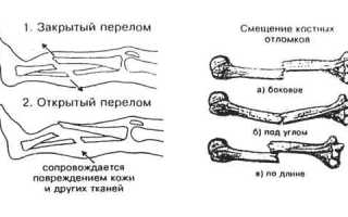Какие препараты с кальцием принимать при переломах для быстрого восстановления?