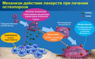 Бисфосфонаты для успешного лечения остеопороза: эффективность и рекомендации