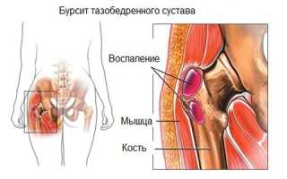 Симптоматическое проявление трохантерита и способы его лечения: важные аспекты