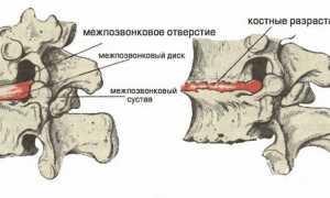 Признаки межреберного хондроза и методы его лечения: полезная информация для пациентов