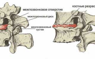 Признаки межреберного хондроза и методы его лечения: полезная информация для пациентов