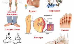 Причины боли в пятке сбоку с внутренней стороны: возможные факторы и рекомендации