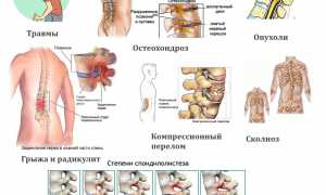Что делать при смещении позвонков грудного отдела? Полезные советы и рекомендации