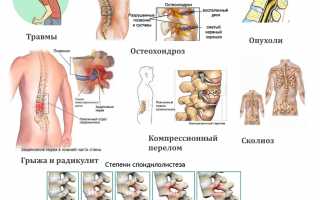 Что делать при смещении позвонков грудного отдела? Полезные советы и рекомендации