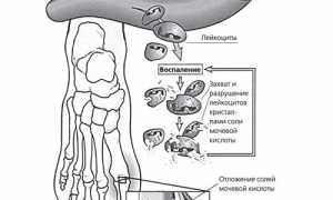 Лечение подагрического артрита суставов: эффективные методы и рекомендации