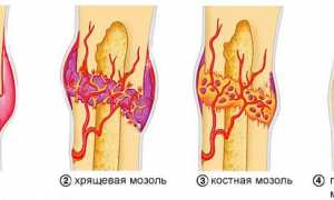 Обзор препаратов для сращивания костей при переломах: эффективность и применение