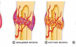 Обзор препаратов для сращивания костей при переломах: эффективность и применение