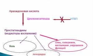 Как лечить межреберную невралгию в домашних условиях эффективно?