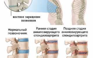Диагностика синдрома фасеточных суставов и его лечение: важные аспекты