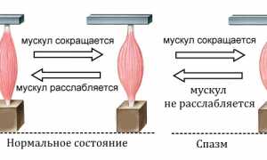 Почему возникает мышечный спазм в спине и как его устранить? Полезные советы