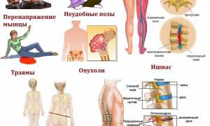 Диагностика и лечение синдрома грушевидной мышцы: советы и рекомендации