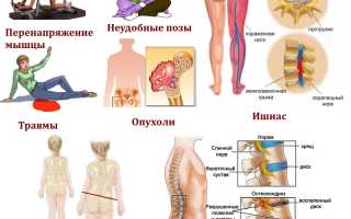 Диагностика и лечение синдрома грушевидной мышцы: советы и рекомендации