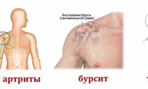 Признаки появления кисты плечевого сустава и ее лечение: важные аспекты здоровья