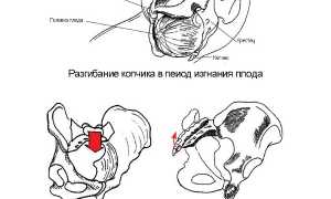 Проявление вывиха копчика и особенности лечения в медицинской практике
