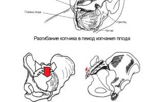 Проявление вывиха копчика и особенности лечения в медицинской практике