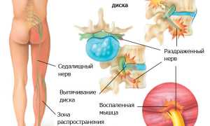 Может ли рассосаться межпозвоночная грыжа? Узнайте мнение специалистов