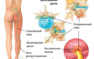 Может ли рассосаться межпозвоночная грыжа? Узнайте мнение специалистов