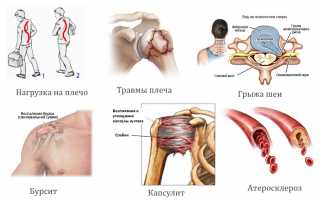 Лечебные мероприятия при плечелопаточном периартрозе: советы и рекомендации