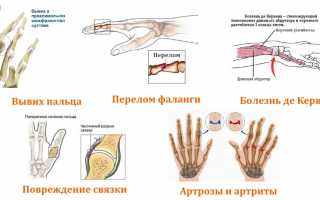 Как подобрать и носить ортез на пальцы руки правильно?
