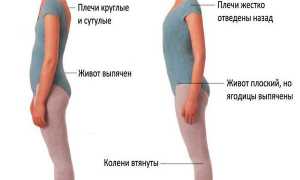Почему появляется сутулость и как от нее избавиться? Полезные советы