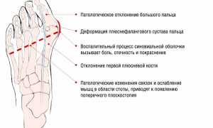 Лазерный метод удаления шишек на ногах: эффективное решение проблемы
