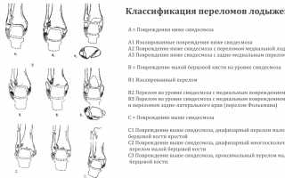 Первая помощь при переломе лодыжки и ее лечение: советы и рекомендации