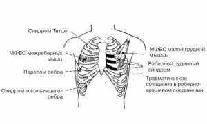 Как проявляется и лечится синдром Титце у пациентов