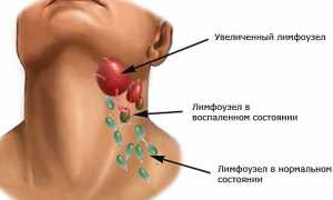 Виды кисты шейного отдела позвоночника и ее лечение: причины и симптомы