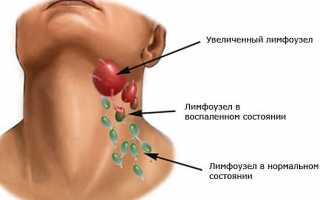 Виды кисты шейного отдела позвоночника и ее лечение: причины и симптомы